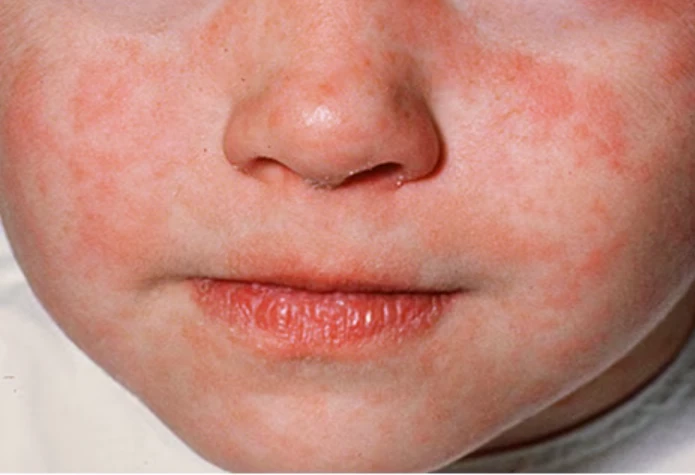 🚨 México contra reloj por brote de sarampión 🇲🇽💉