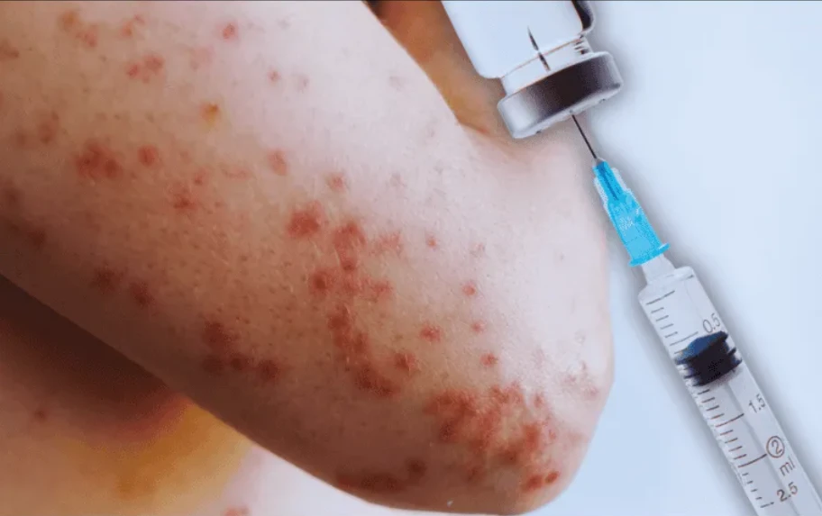 📰 México cuenta con más de 23 millones de vacunas disponibles contra el sarampión